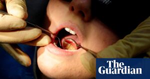 The British Dental Association (BDA) warns that the European Union's ban on silver fillings could result in a dental care emergency in Northern Ireland.