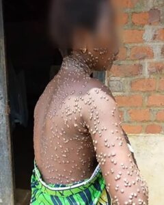 Warnings over lethal and contagious strain of mpox as children in DRC die