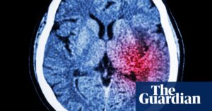 Algorithm could help prevent thousands of strokes in UK each year